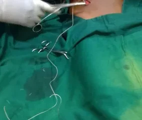 Buikoperatie van 1 van de kinderen